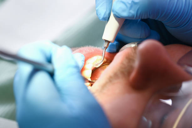Best Knocked-Out Tooth (Avulsed Tooth) Treatment in Tok, AK